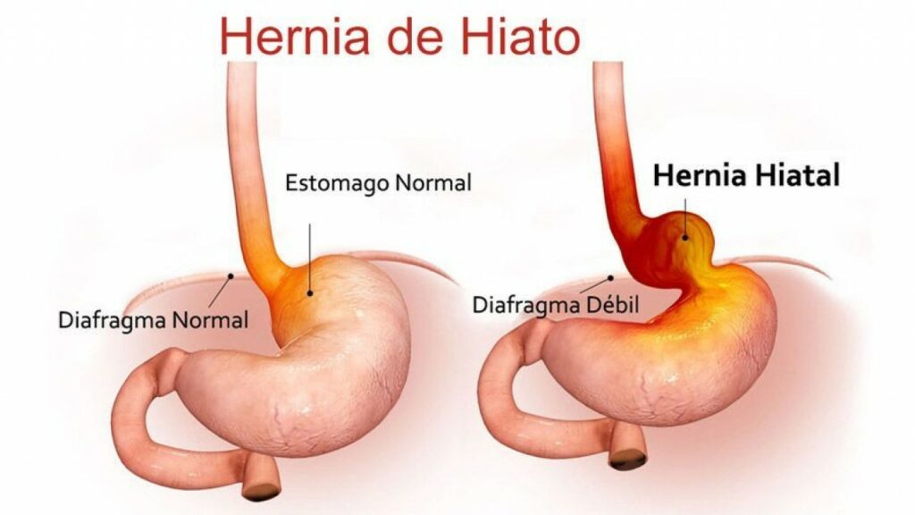 Hernia de hiato Dieta