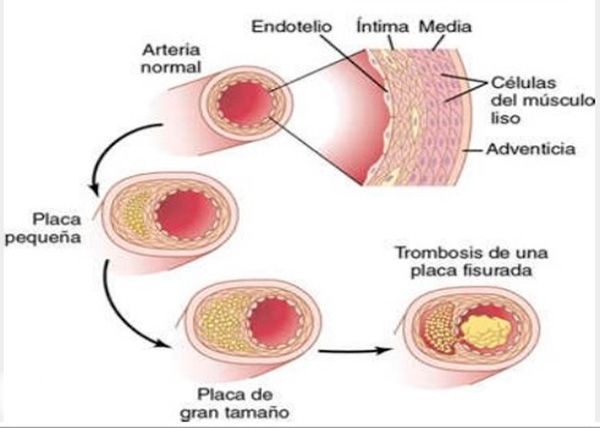 Hipercolesterolemia, dieta para bajar el colesterol