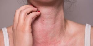alergia alimenticia
