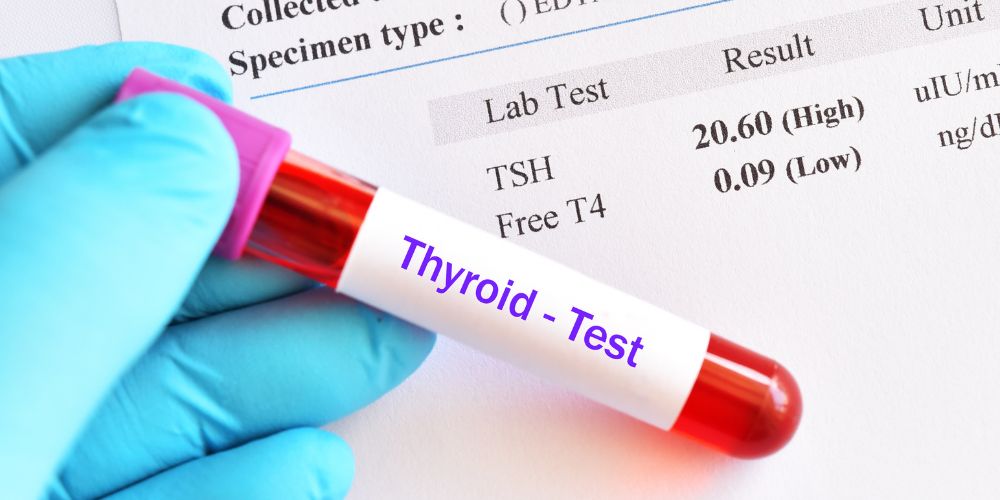 Un tubo de sangre con un texto escrito que dice "Thyroid-Test". Debajo hay una analítica en papel que muestra los valores de TSH y Free T4.