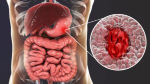 Colitis ulcerosa señalada en un modelo virtual